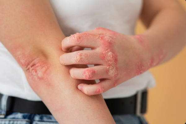 Kroonilised nahaprobieemid